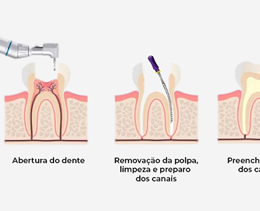 Tratamento de Canal